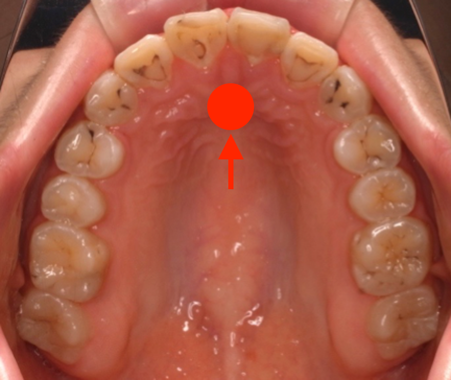 歯科衛生士と食育 第４回 知れば声かけが変わる 綺麗な歯並びを作るために 歯科衛生士のための医院研修とセミナー ラ プレシャス La Precious
