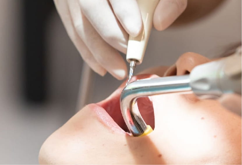 超音波スケーリング