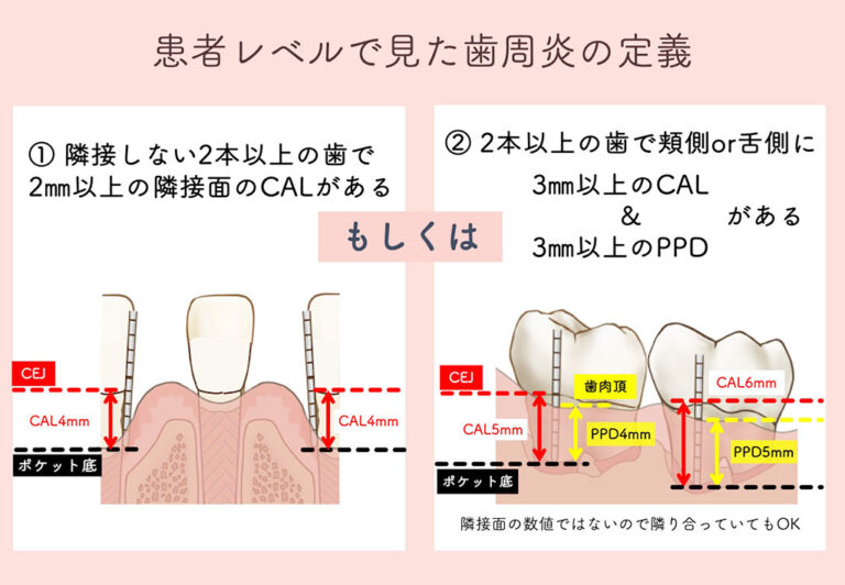 歯周病新分類を理解しよう!その2『歯周炎を知ろう』 - 歯科衛生士のための医院研修とレッスンとセミナー 株式会社ラ・プレシャス( LA ...